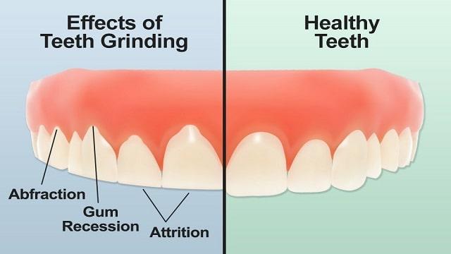 Bruxism Symptoms, Risk Factors & Treatment | Diseases List A-Z